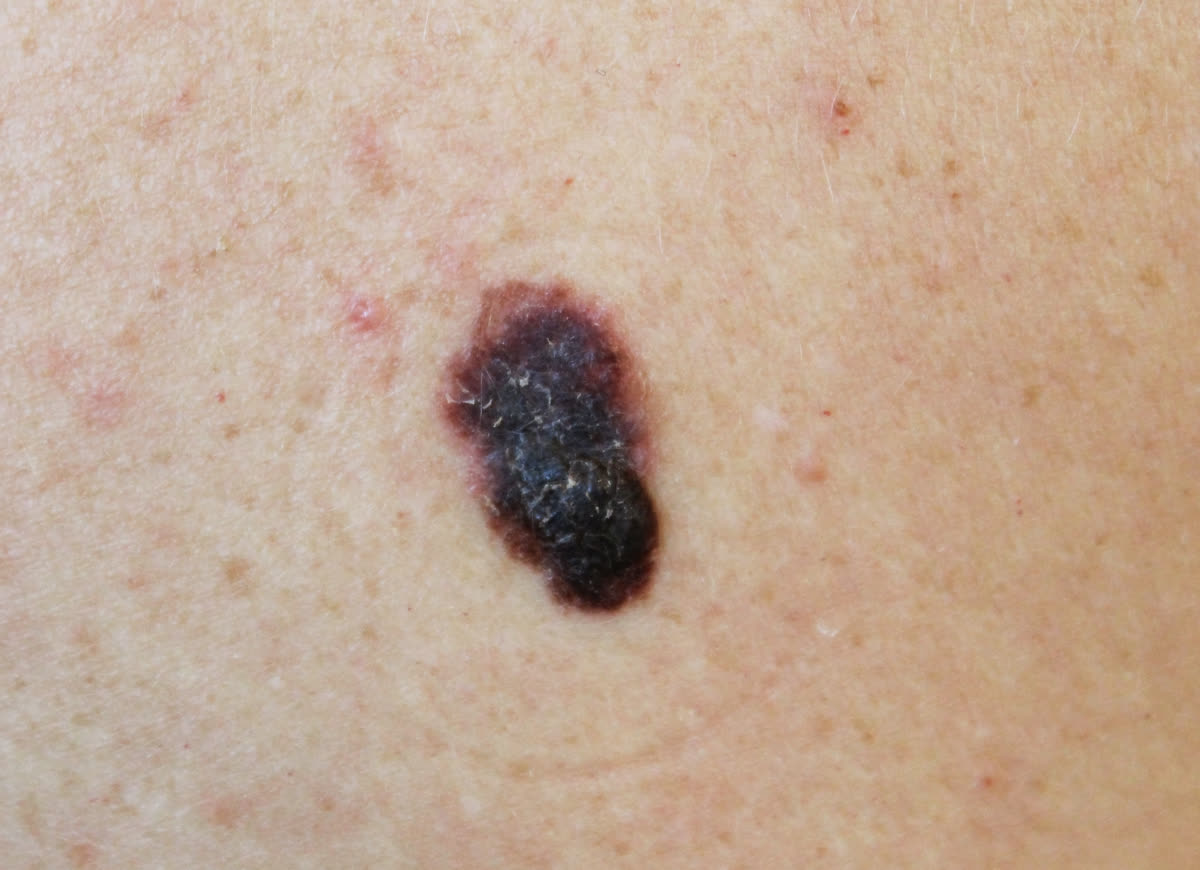 Irregular melanoma with uneven borders and multiple shades of brown and black