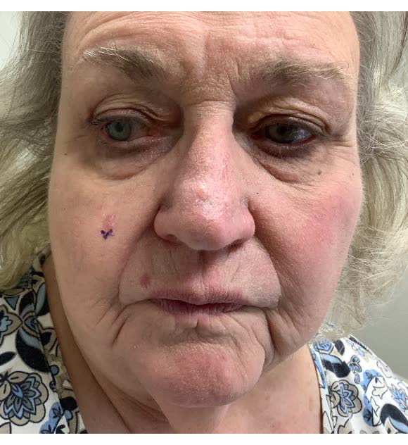 Mohs case 1 &mdash; Before: basal cell carcinoma on the right cheek