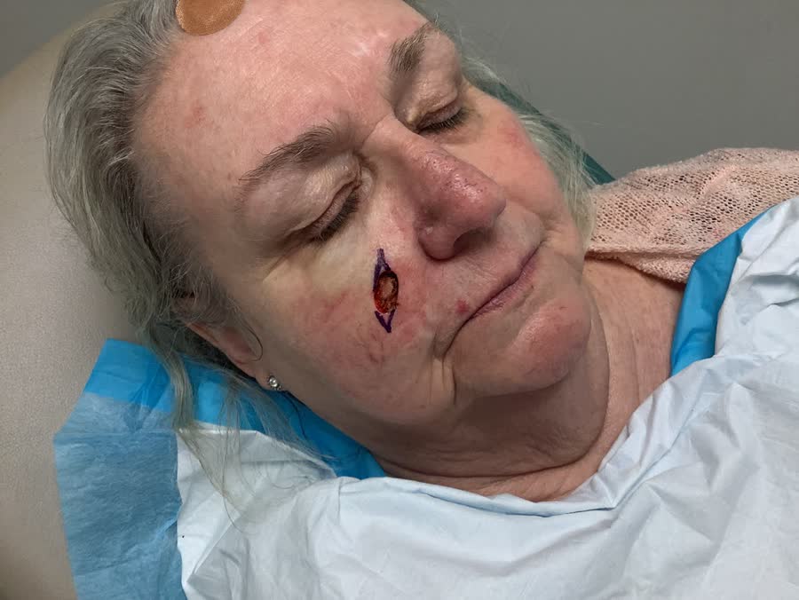 Mohs case 1 &mdash; After cancer removal: basal cell carcinoma on the right cheek