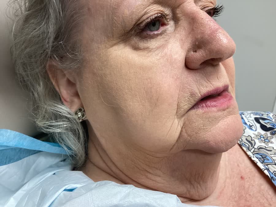 Mohs case 1 &mdash; Healed: basal cell carcinoma on the right cheek