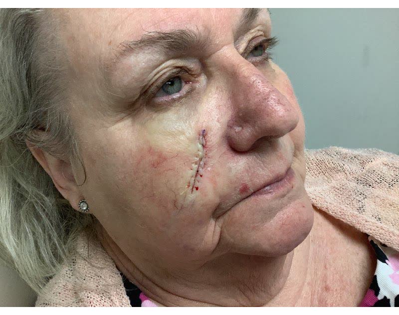 Mohs case 1 &mdash; Repair &middot; same day: basal cell carcinoma on the right cheek