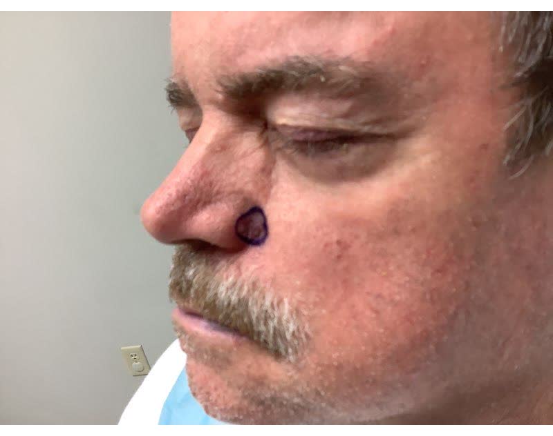 Mohs case 2 &mdash; Before: basal cell carcinoma involving the cheek and nose