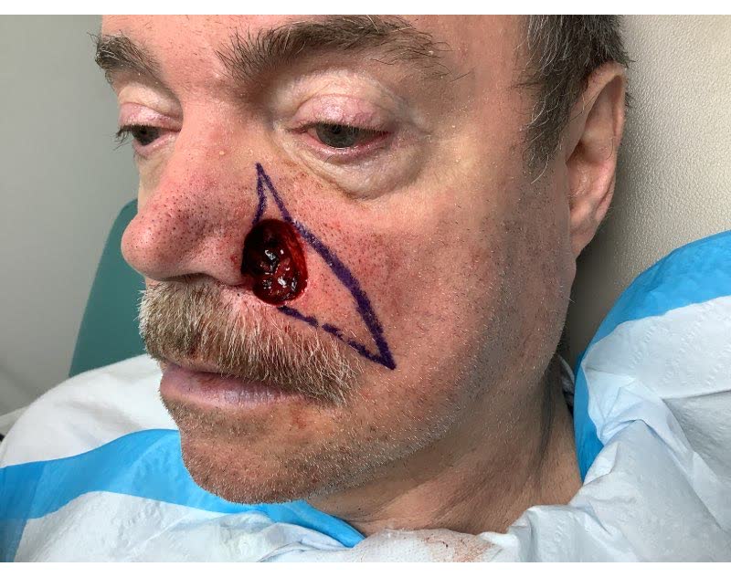 Mohs case 2 &mdash; After cancer removal: basal cell carcinoma involving the cheek and nose