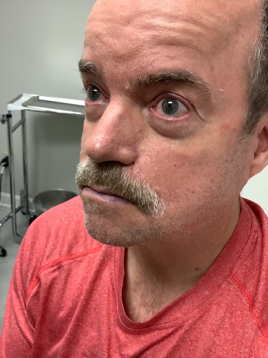 Mohs case 2 &mdash; Healed: basal cell carcinoma involving the cheek and nose