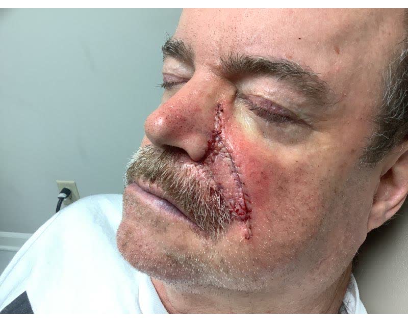 Mohs case 2 &mdash; Repair &middot; same day: basal cell carcinoma involving the cheek and nose