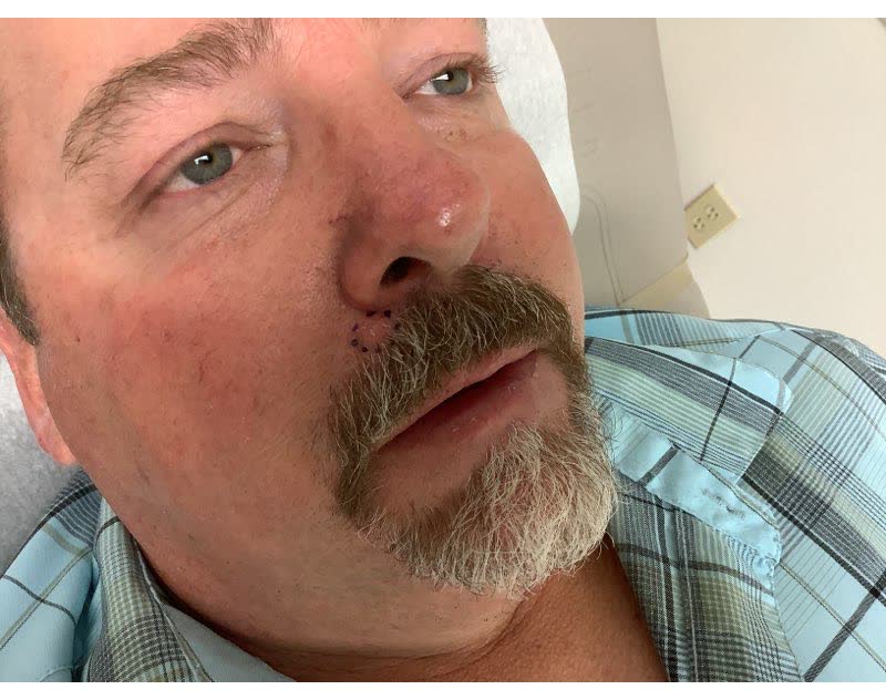 Mohs case 3 &mdash; Before: basal cell carcinoma on the right upper lip