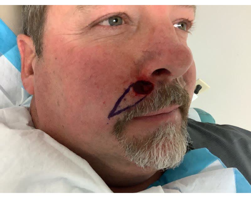 Mohs case 3 &mdash; After cancer removal: basal cell carcinoma on the right upper lip