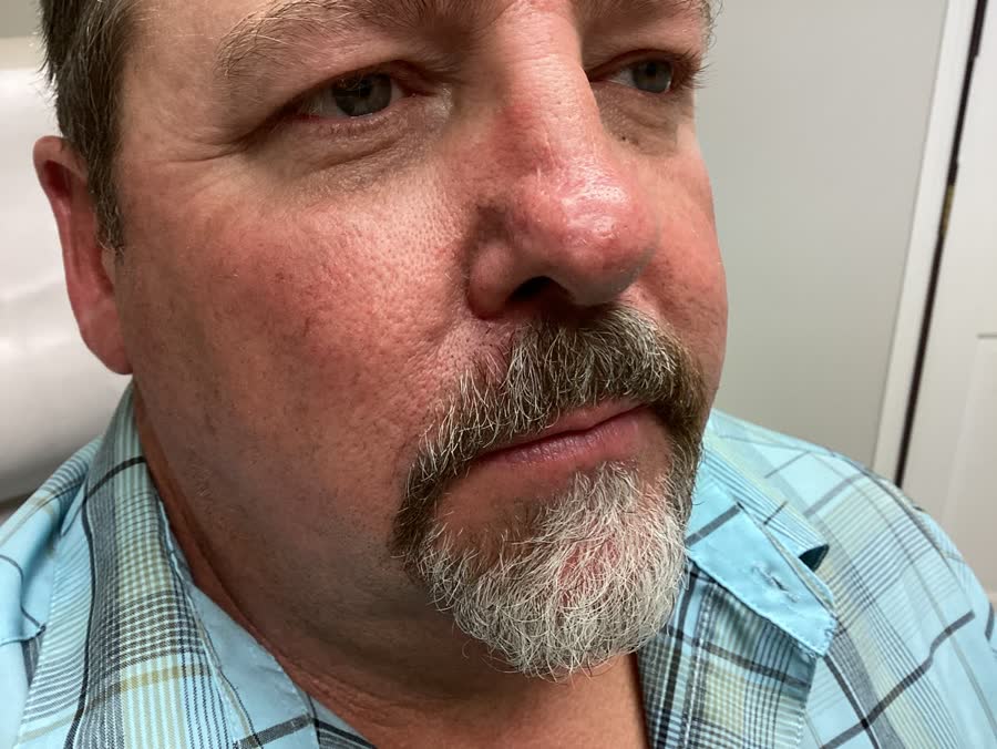 Mohs case 3 &mdash; Healed: basal cell carcinoma on the right upper lip