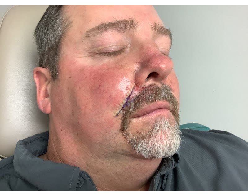 Mohs case 3 &mdash; Repair &middot; same day: basal cell carcinoma on the right upper lip