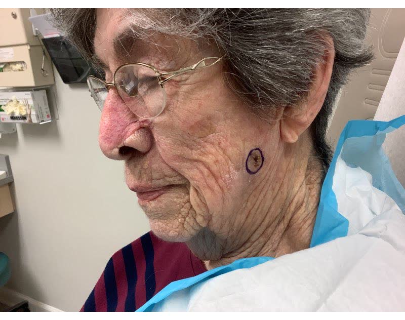Mohs case 4 &mdash; Before: squamous cell carcinoma on the left cheek