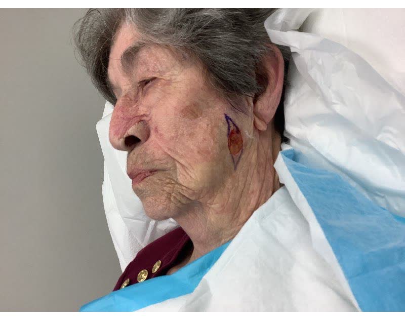 Mohs case 4 &mdash; After cancer removal: squamous cell carcinoma on the left cheek