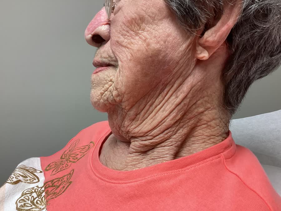 Mohs case 4 &mdash; Healed: squamous cell carcinoma on the left cheek