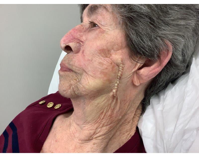 Mohs case 4 &mdash; Repair &middot; same day: squamous cell carcinoma on the left cheek
