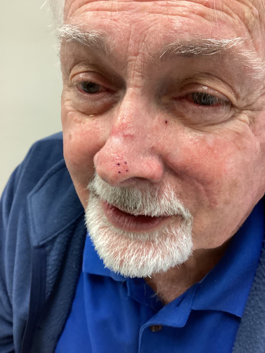 Mohs case 5 &mdash; Before: basal cell carcinoma on the nasal supratip