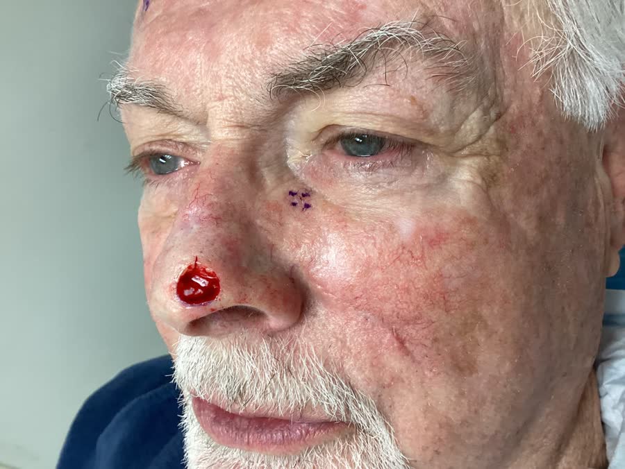 Mohs case 5 &mdash; After cancer removal: basal cell carcinoma on the nasal supratip