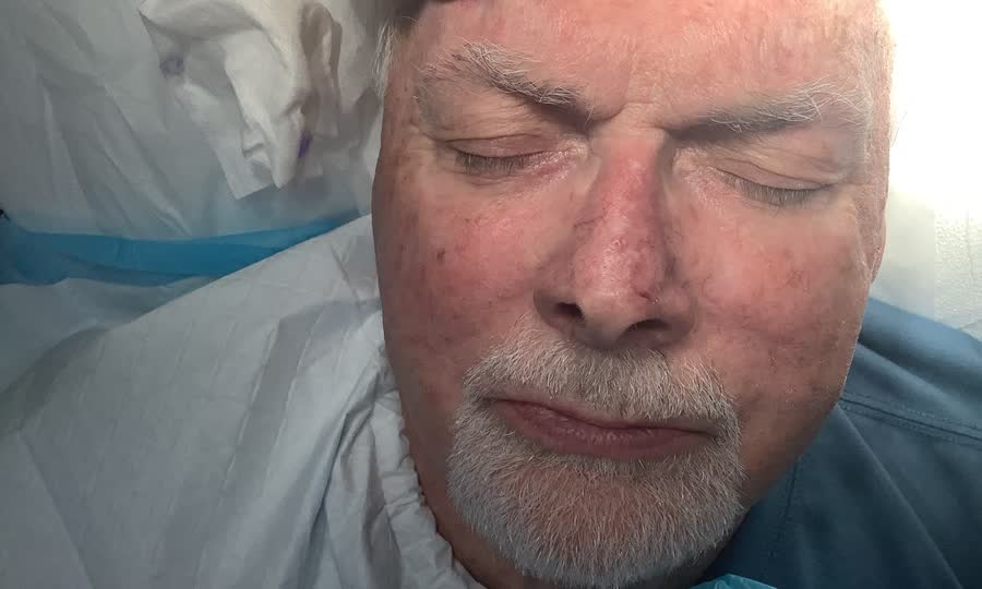 Mohs case 5 &mdash; Healed: basal cell carcinoma on the nasal supratip
