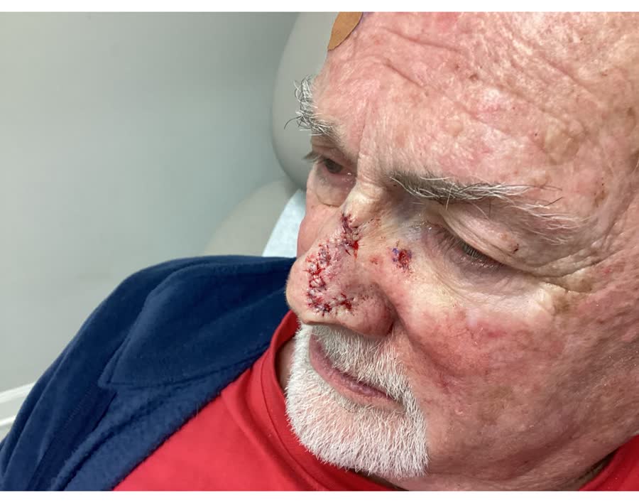 Mohs case 5 &mdash; Repair &middot; same day: basal cell carcinoma on the nasal supratip