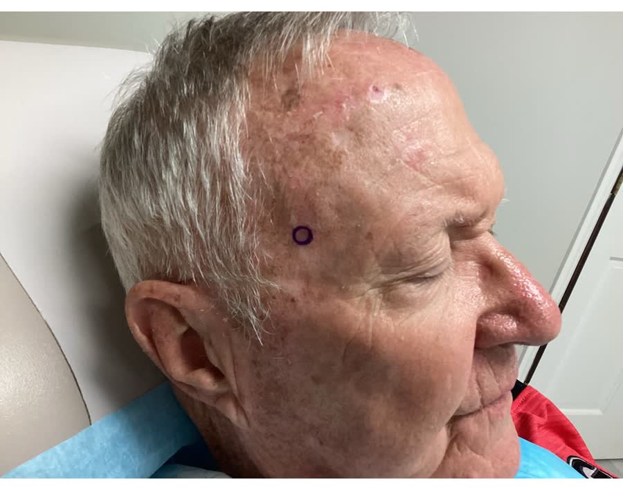 Mohs case 6 &mdash; Before: squamous cell carcinoma on the right forehead