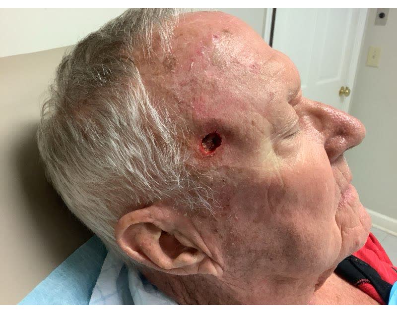 Mohs case 6 &mdash; After cancer removal: squamous cell carcinoma on the right forehead