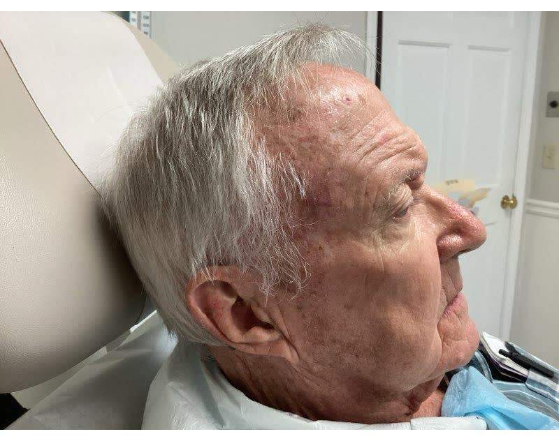 Mohs case 6 &mdash; Healed: squamous cell carcinoma on the right forehead