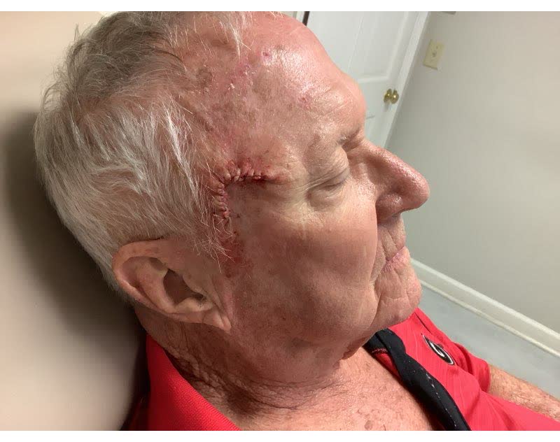 Mohs case 6 &mdash; Repair &middot; same day: squamous cell carcinoma on the right forehead