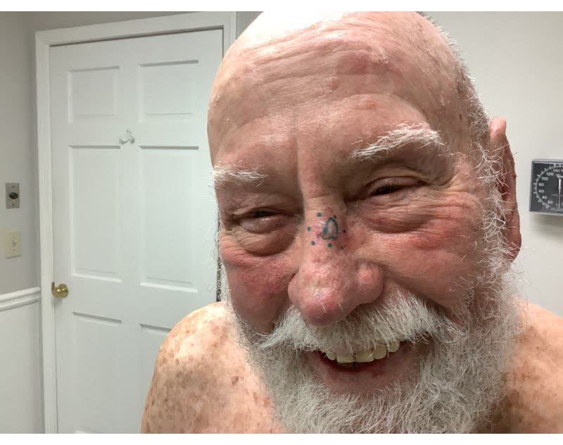 Mohs case 7 &mdash; Before: squamous cell carcinoma on the nose