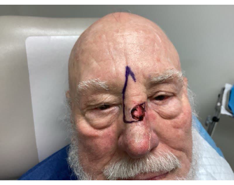 Mohs case 7 &mdash; After cancer removal: squamous cell carcinoma on the nose
