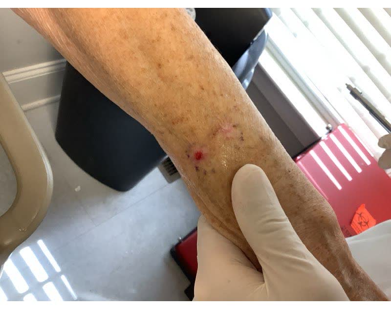 Mohs case 8 &mdash; Before: two infiltrative basal cell carcinomas on the left forearm