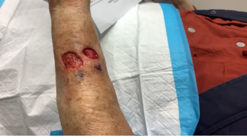 Mohs case 8 &mdash; After cancer removal: two infiltrative basal cell carcinomas on the left forearm