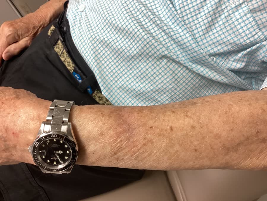 Mohs case 8 &mdash; Healed: two infiltrative basal cell carcinomas on the left forearm