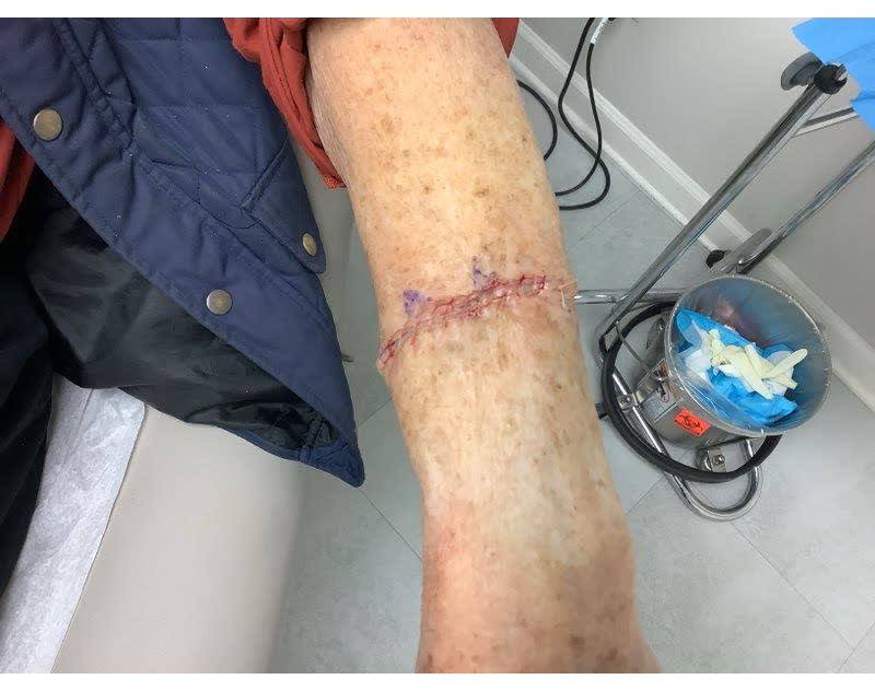 Mohs case 8 &mdash; Repair &middot; same day: two infiltrative basal cell carcinomas on the left forearm