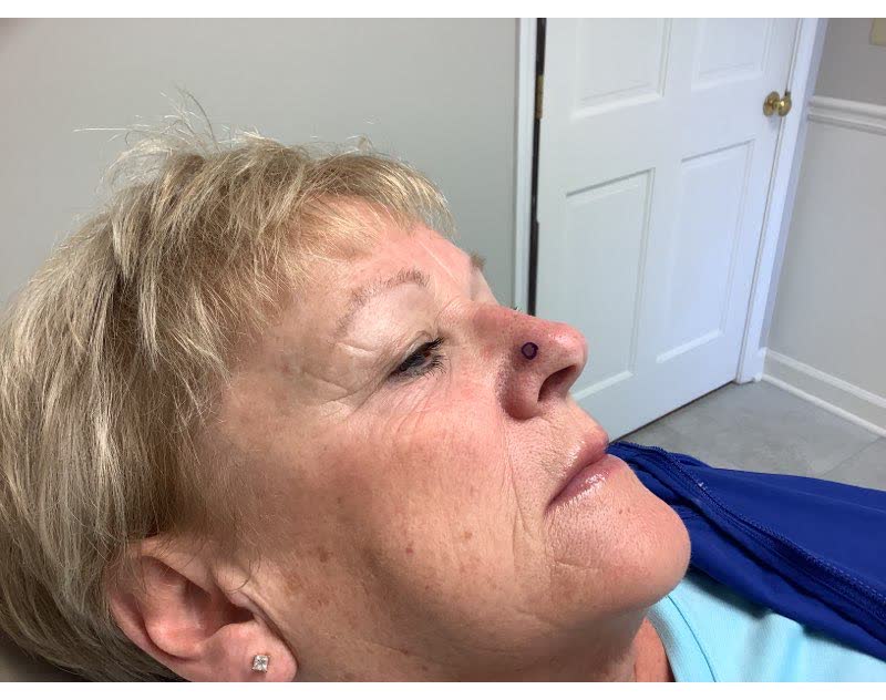 Mohs case 9 &mdash; Before: basal cell carcinoma on the nasal sidewall