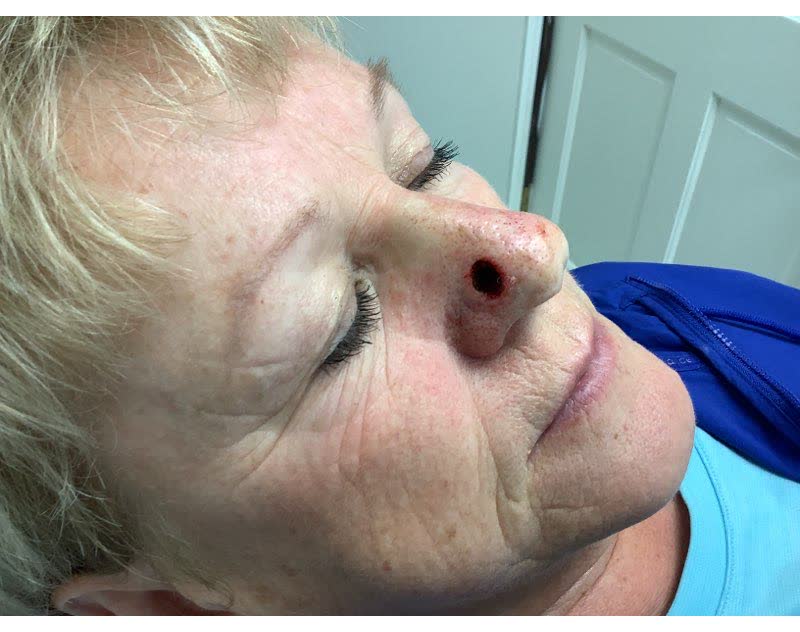 Mohs case 9 &mdash; After cancer removal: basal cell carcinoma on the nasal sidewall