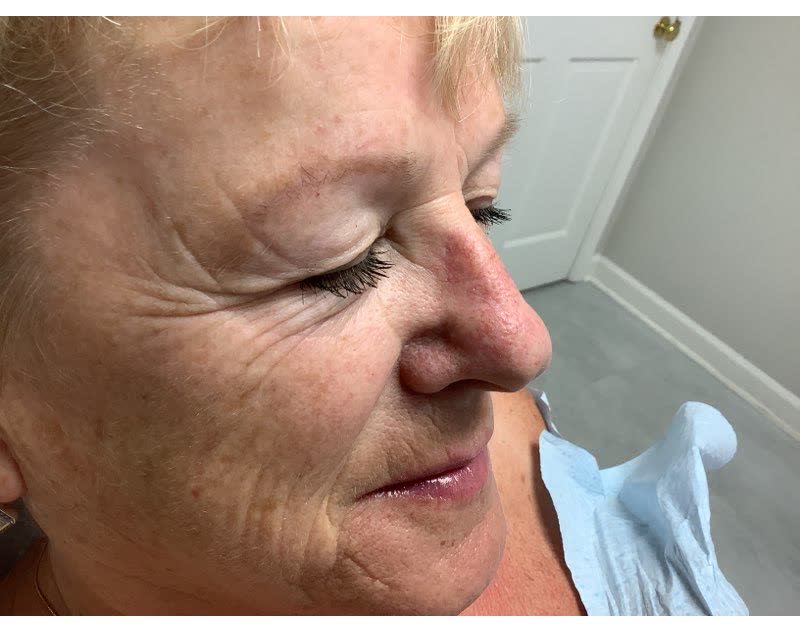 Mohs case 9 &mdash; Healed: basal cell carcinoma on the nasal sidewall