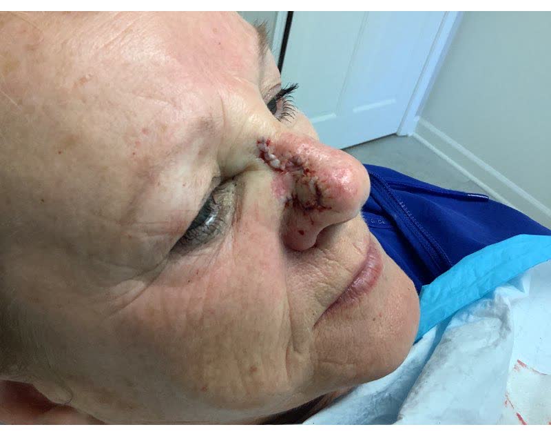 Mohs case 9 &mdash; Repair &middot; same day: basal cell carcinoma on the nasal sidewall