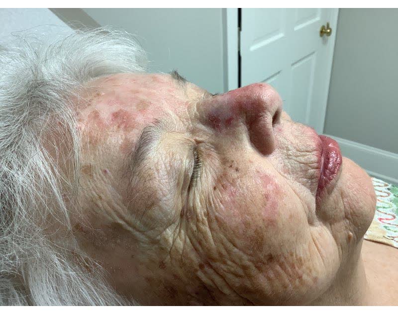 Mohs case 10 &mdash; Before: squamous cell carcinoma on the nose