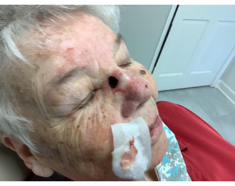Mohs case 10 &mdash; After cancer removal: squamous cell carcinoma on the nose