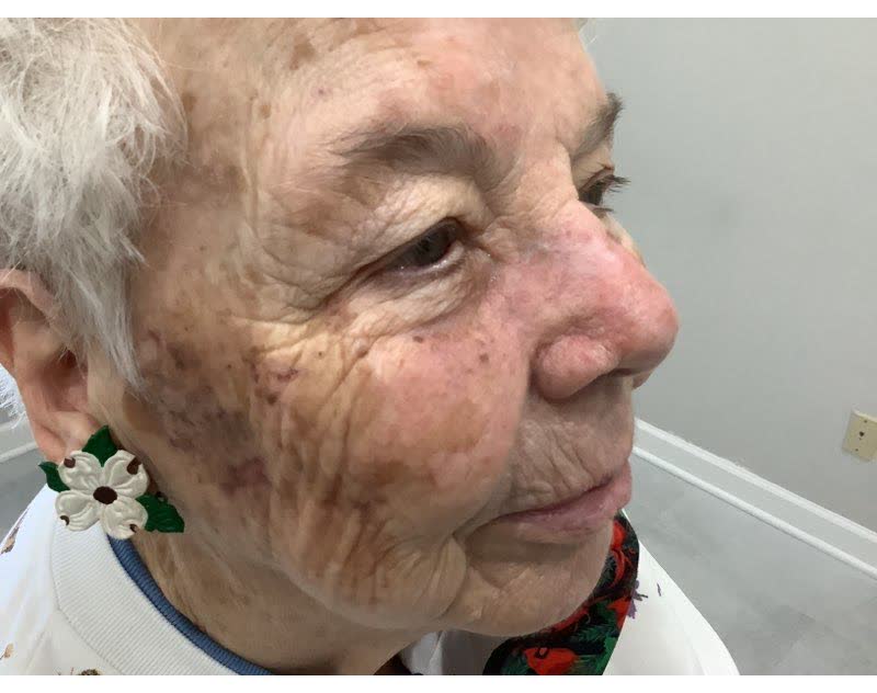 Mohs case 10 &mdash; Healed: squamous cell carcinoma on the nose