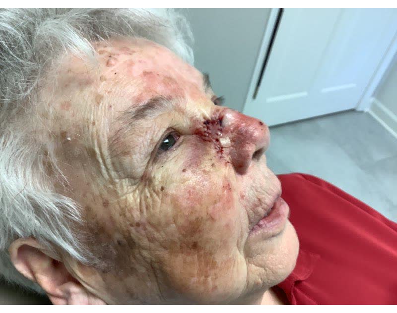 Mohs case 10 &mdash; Repair &middot; same day: squamous cell carcinoma on the nose