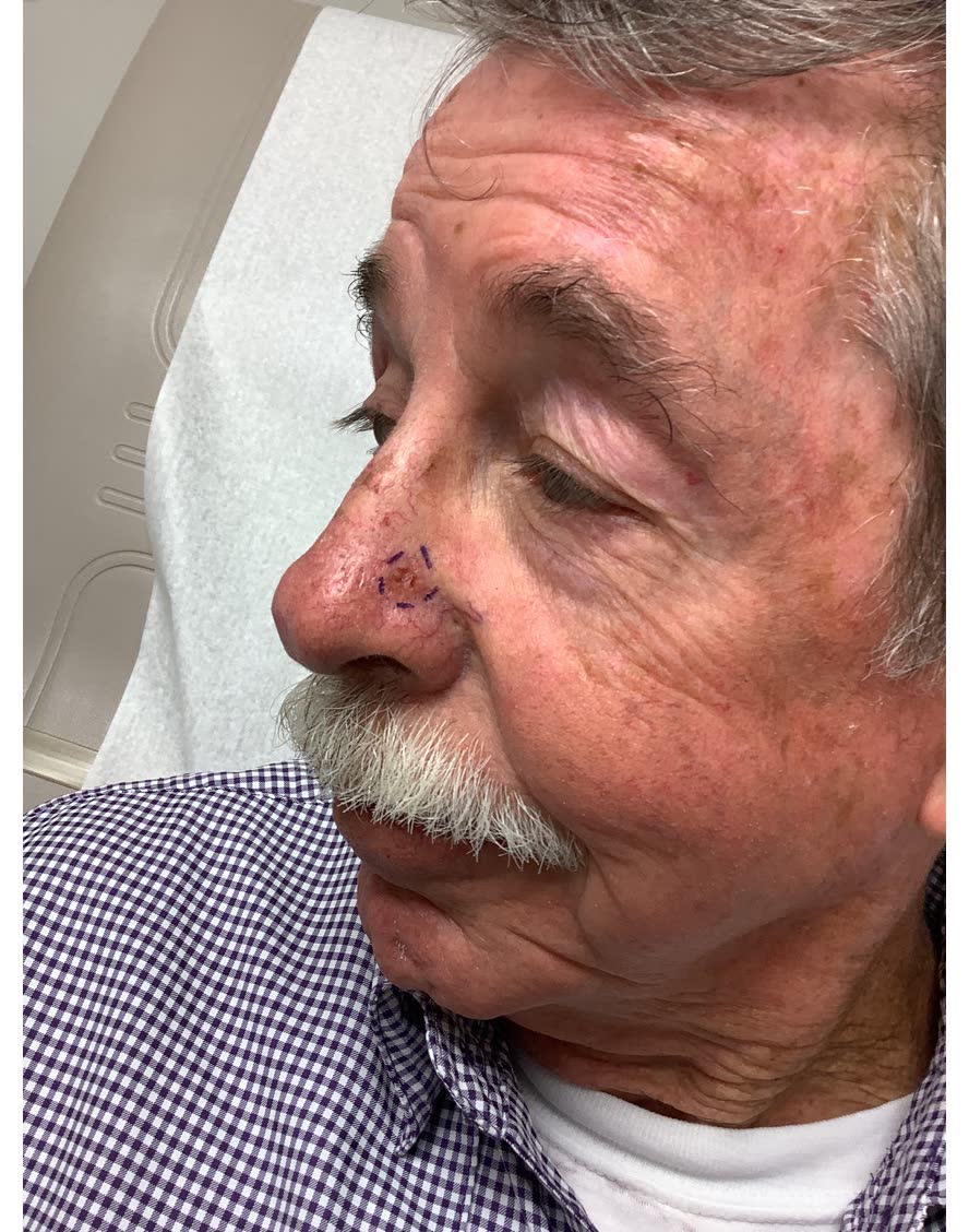 Mohs case 11 &mdash; Before: infiltrative basal cell carcinoma on the nose