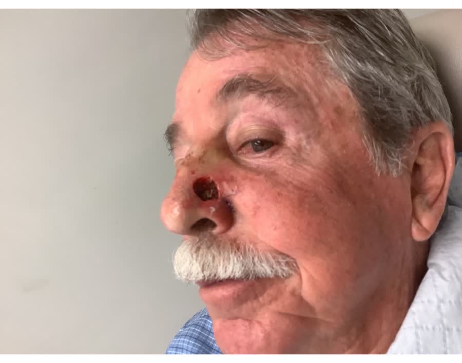 Mohs case 11 &mdash; After cancer removal: infiltrative basal cell carcinoma on the nose