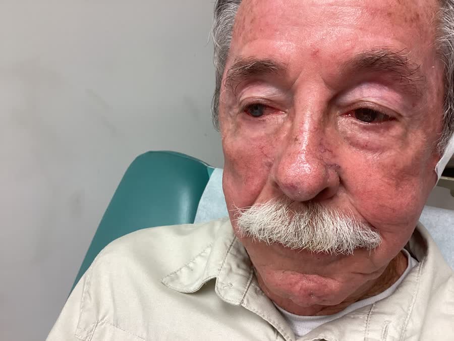 Mohs case 11 &mdash; Healed: infiltrative basal cell carcinoma on the nose