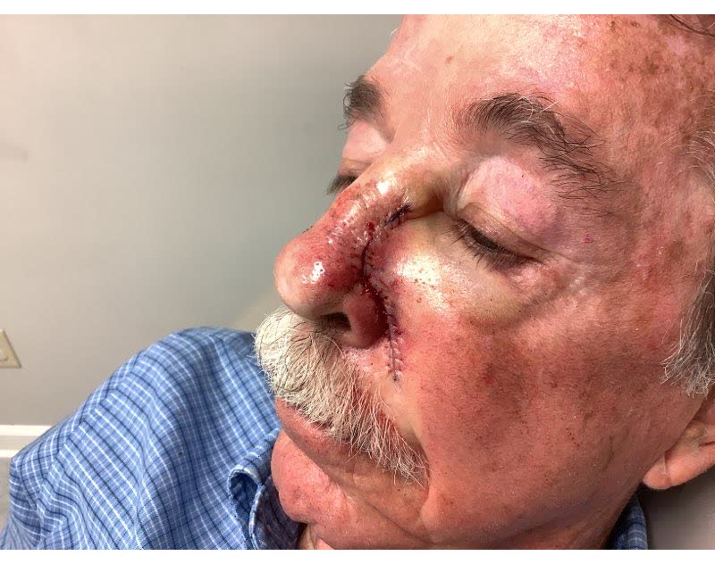 Mohs case 11 &mdash; Repair &middot; same day: infiltrative basal cell carcinoma on the nose