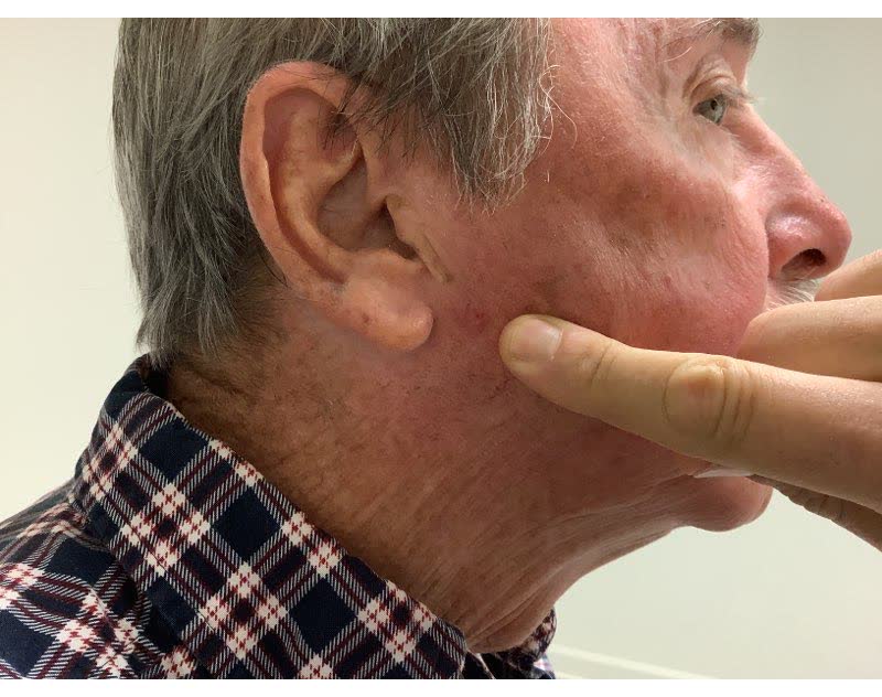 Mohs case 12 &mdash; Before: infiltrative basal cell carcinoma on the right cheek
