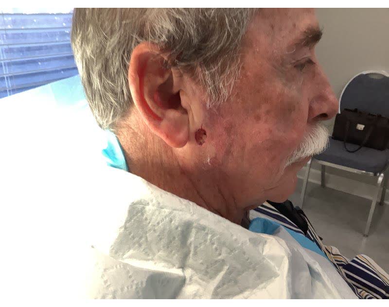 Mohs case 12 &mdash; After cancer removal: infiltrative basal cell carcinoma on the right cheek