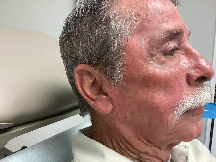 Mohs case 12 &mdash; Healed: infiltrative basal cell carcinoma on the right cheek