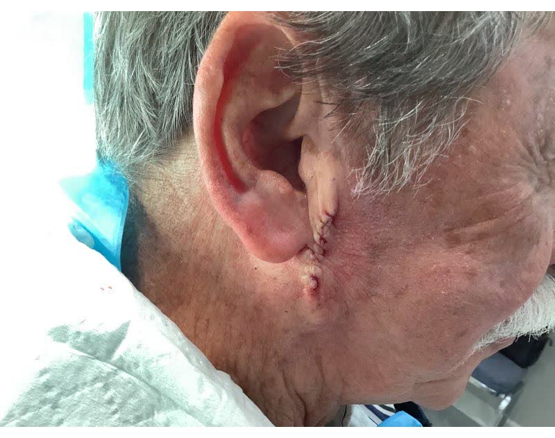 Mohs case 12 &mdash; Repair &middot; same day: infiltrative basal cell carcinoma on the right cheek