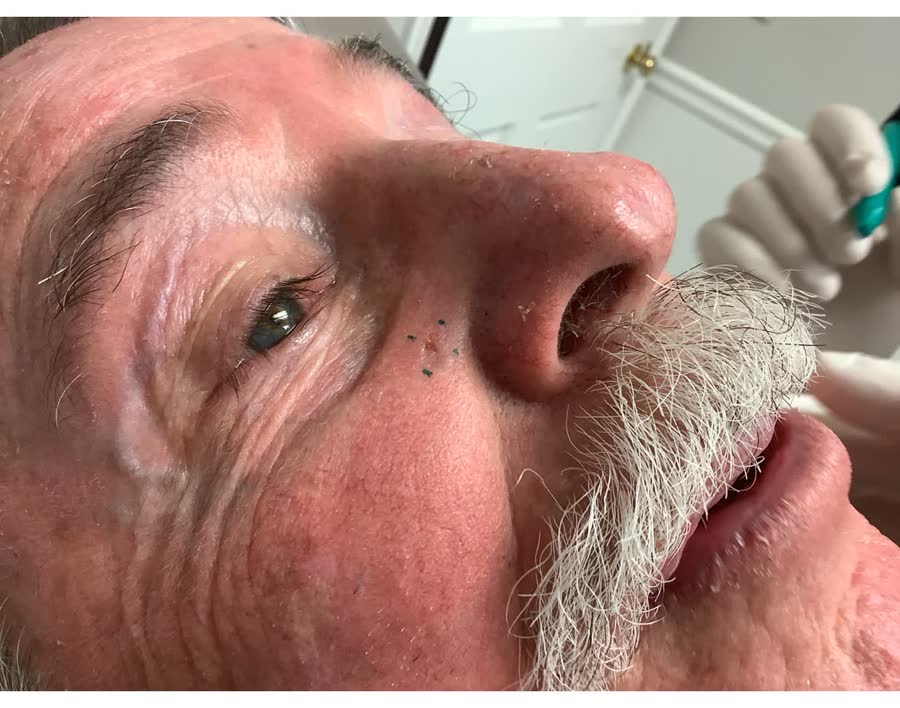 Mohs case 13 &mdash; Before: basal cell carcinoma on the right cheek near the nose