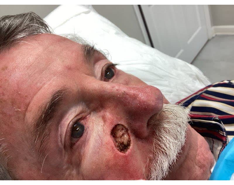 Mohs case 13 &mdash; After cancer removal: basal cell carcinoma on the right cheek near the nose