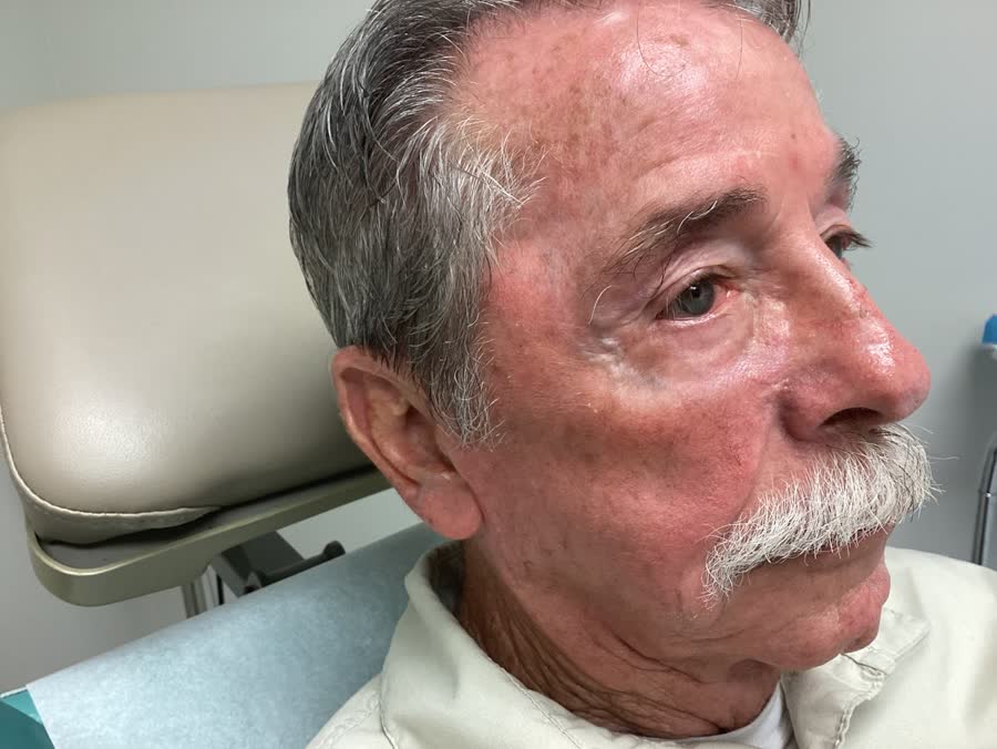 Mohs case 13 &mdash; Healed: basal cell carcinoma on the right cheek near the nose